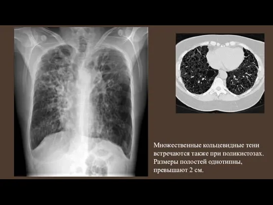 Множественные кольцевидные тени встречаются также при поликистозах. Размеры полостей однотипны, превышают 2 см.