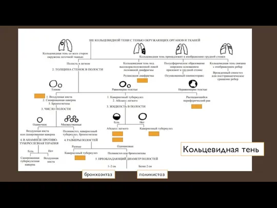 поликистоз бронхоэктаз Кольцевидная тень