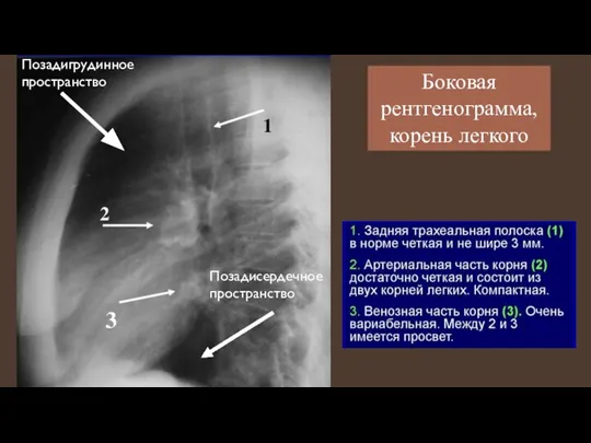 Боковая рентгенограмма, корень легкого Позадигрудинное пространство Позадисердечное пространство