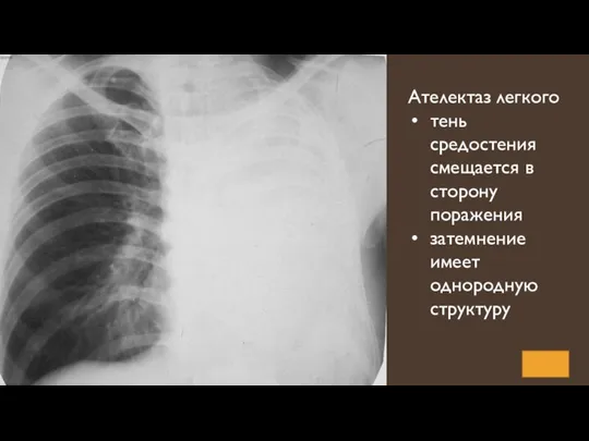 Ателектаз легкого тень средостения смещается в сторону поражения затемнение имеет однородную структуру