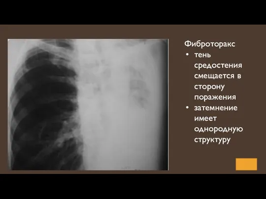 Фиброторакс тень средостения смещается в сторону поражения затемнение имеет однородную структуру