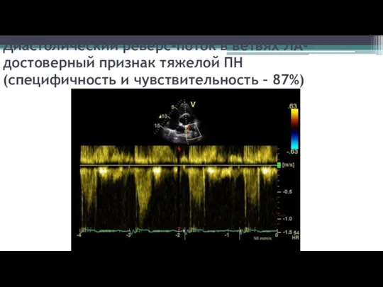 Диастолический реверс-поток в ветвях ЛА- достоверный признак тяжелой ПН (специфичность и чувствительность – 87%)