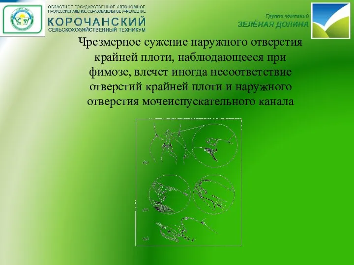 Чрезмерное сужение наружного отверстия крайней плоти, наблюдающееся при фимозе, влечет иногда несоответствие