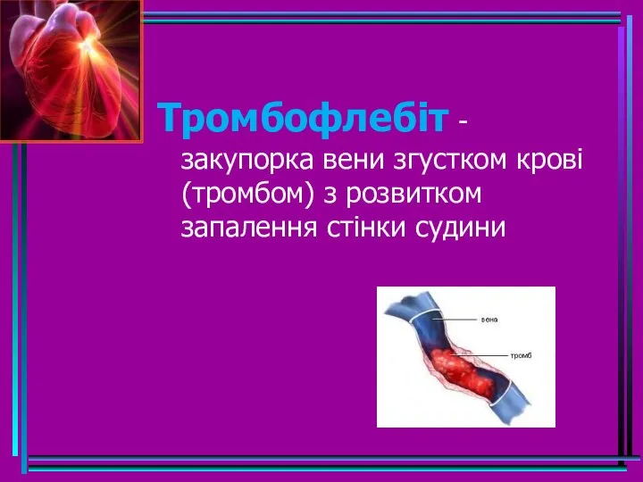 Тромбофлебіт - закупорка вени згустком крові (тромбом) з розвитком запалення стінки судини