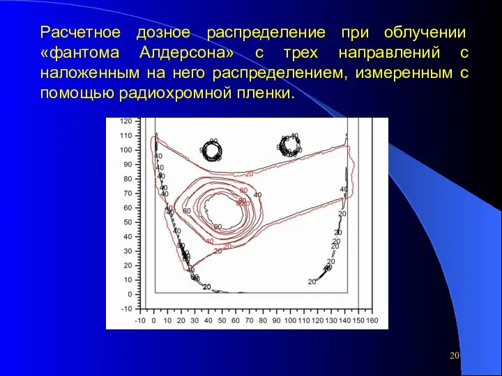 Расчетное дозное распределение при облучении «фантома Алдерсона» с трех направлений с наложенным