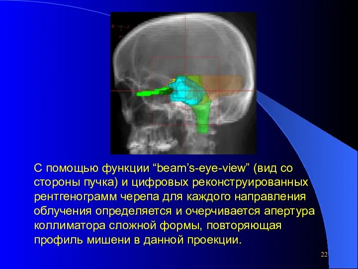 С помощью функции “beam’s-eye-view” (вид со стороны пучка) и цифровых реконструированных рентгенограмм