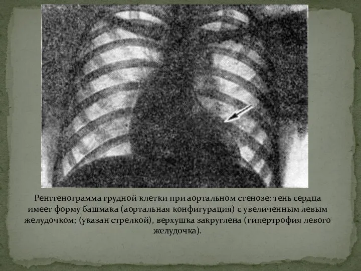 Рентгенограмма грудной клетки при аортальном стенозе: тень сердца имеет форму башмака (аортальная