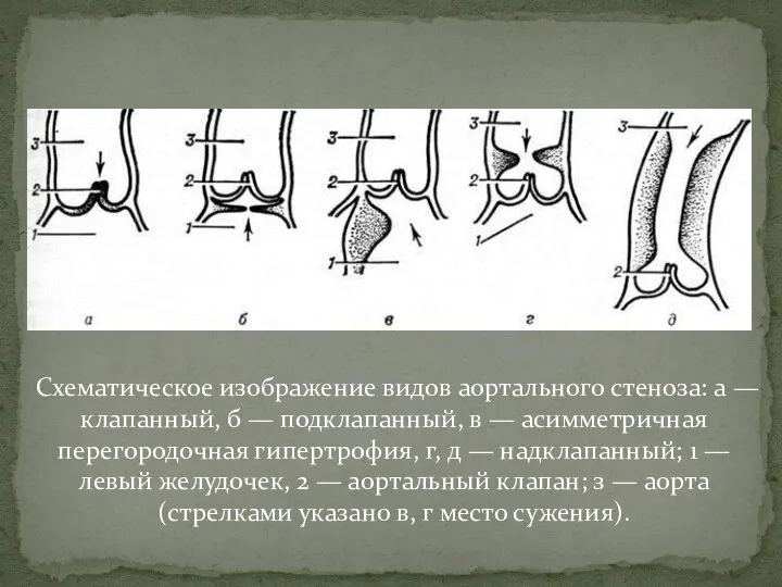 Схематическое изображение видов аортального стеноза: а — клапанный, б — подклапанный, в