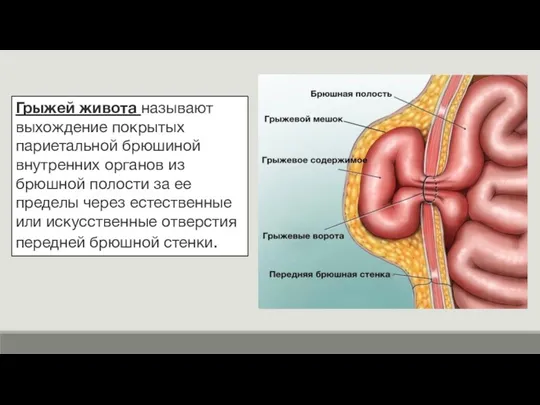 Грыжей живота называют выхождение покрытых париетальной брюшиной внутренних органов из брюшной полости