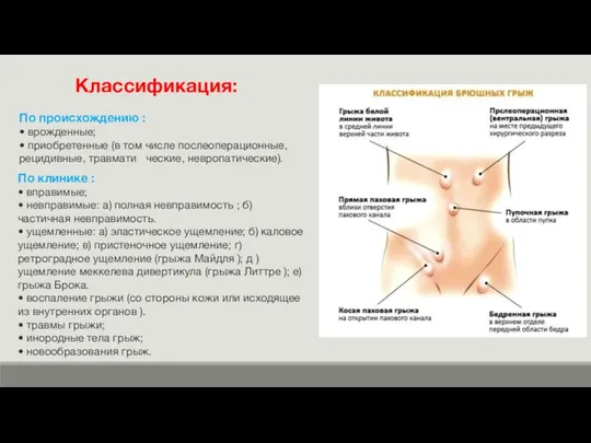 Классификация: По происхождению : • врожденные; • приобретенные (в том числе послеоперационные,