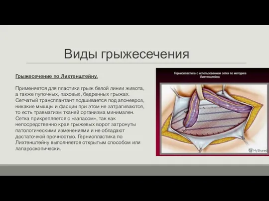 Виды грыжесечения Грыжесечение по Лихтенштейну. Применяется для пластики грыж белой линии живота,