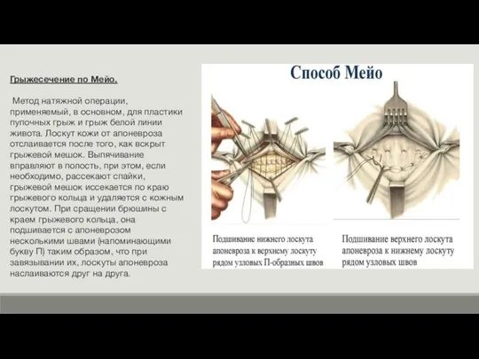 Грыжесечение по Мейо. Метод натяжной операции, применяемый, в основном, для пластики пупочных