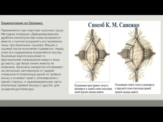 Грыжесечение по Сапежко. Применяется при пластике пупочных грыж. Методика операции: Деформированная дряблая
