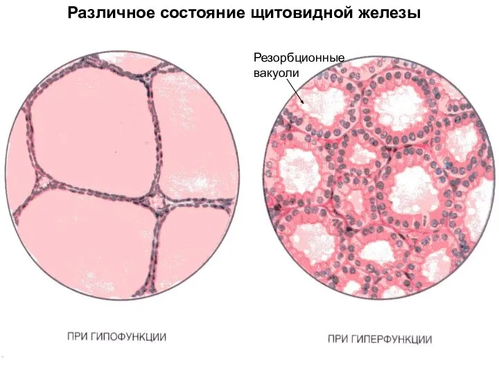 Различное состояние щитовидной железы Резорбционные вакуоли