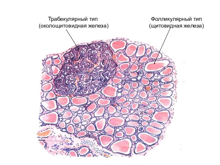 Трабекулярный тип (околощитовидная железа) Фолликулярный тип (щитовидная железа)