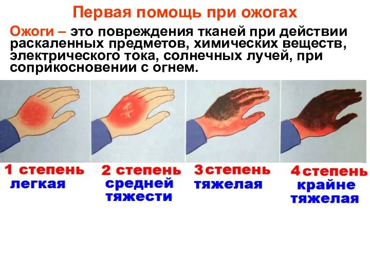 Первая помощь при ожогах Ожоги – это повреждения тканей при действии раскаленных