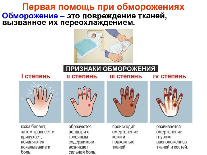 Обморожение – это повреждение тканей, вызванное их переохлаждением. Первая помощь при обморожениях