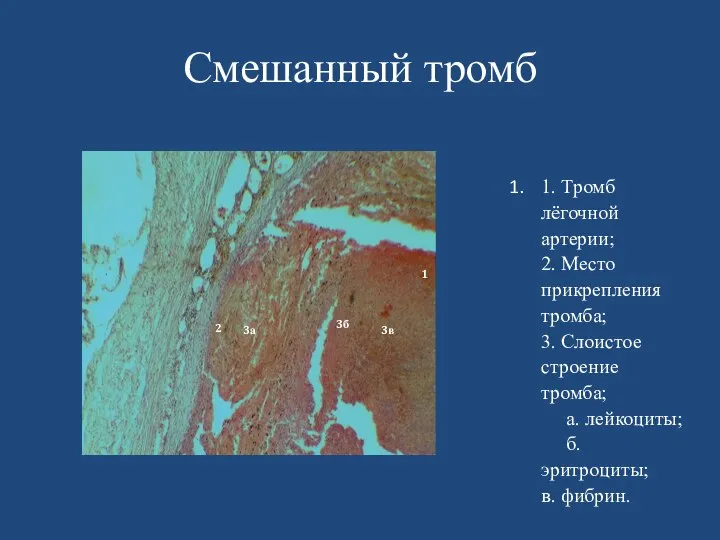 Смешанный тромб 1. Тромб лёгочной артерии; 2. Место прикрепления тромба; 3. Слоистое