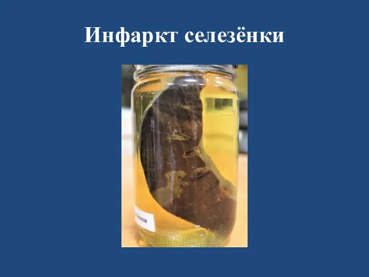 Инфаркт селезёнки