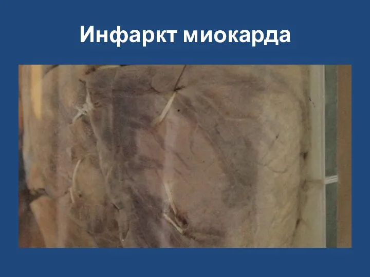 Инфаркт миокарда