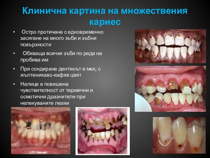 Клинична картина на множествения кариес Остро протичане с едновременно засягане на много