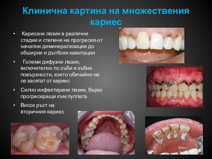 Клинична картина на множествения кариес Кариозни лезии в различни стадии и степени