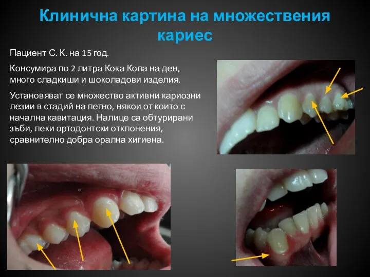 Клинична картина на множествения кариес Пациент С. К. на 15 год. Консумира