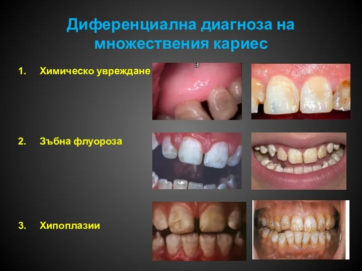 Диференциална диагноза на множествения кариес Химическо увреждане Зъбна флуороза Хипоплазии