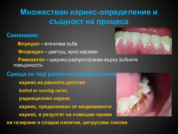 Множествен кариес-определение и същност на процеса Синоними: Флуиден – втечнява зъба Флориден