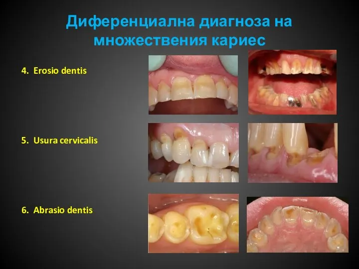 Диференциална диагноза на множествения кариес 4. Erosio dentis 5. Usura cervicalis 6. Abrasio dentis