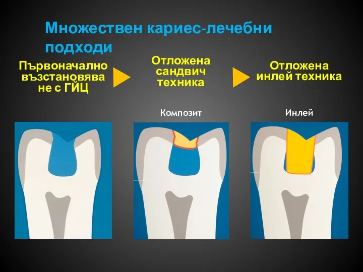 Инлей Композит Множествен кариес-лечебни подходи