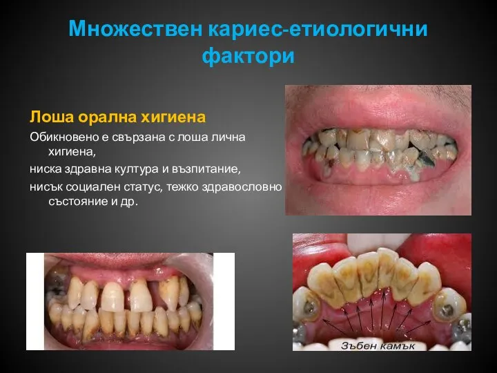 Множествен кариес-етиологични фактори Лоша орална хигиена Обикновено е свързана с лоша лична