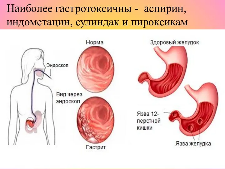 Наиболее гастротоксичны - аспирин, индометацин, сулиндак и пироксикам