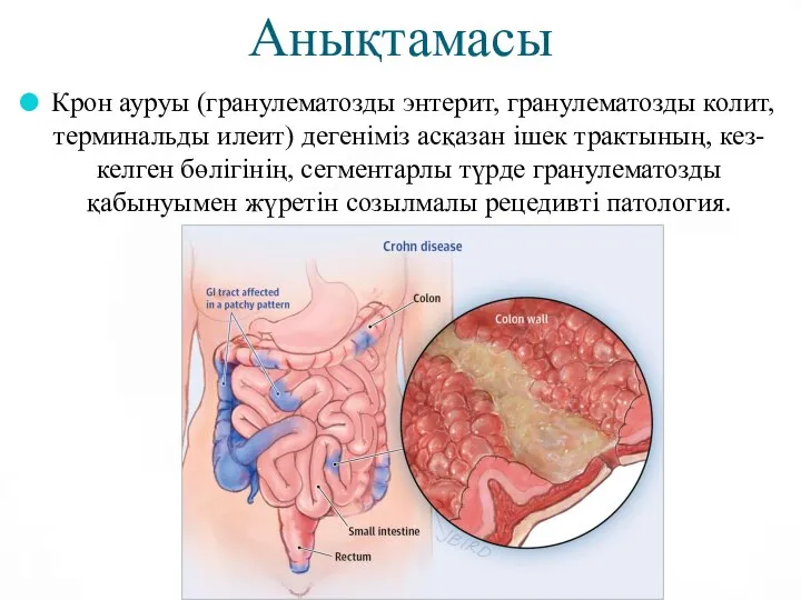 Анықтамасы Крон ауруы (гранулематозды энтерит, гранулематозды колит, терминальды илеит) дегеніміз асқазан ішек