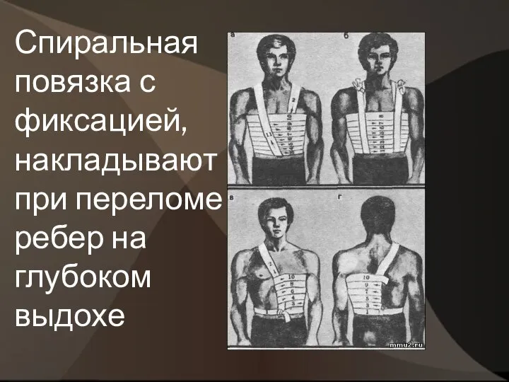 Спиральная повязка с фиксацией, накладывают при переломе ребер на глубоком выдохе