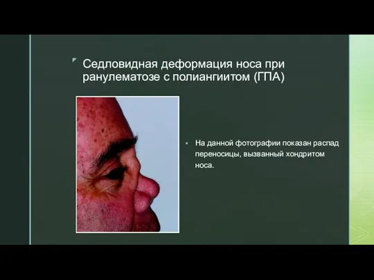 Седловидная деформация носа при ранулематозе с полиангиитом (ГПА) На данной фотографии показан