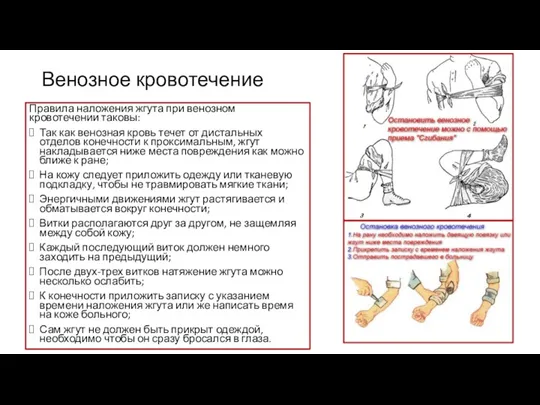 Венозное кровотечение Правила наложения жгута при венозном кровотечении таковы: Так как венозная