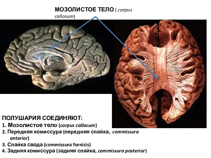 МОЗОЛИСТОЕ ТЕЛО ( corpus callosum) ПОЛУШАРИЯ СОЕДИНЯЮТ: 1. Мозолистое тело (corpus callosum)