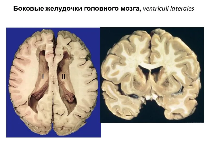 Боковые желудочки головного мозга, ventriculi laterales l II