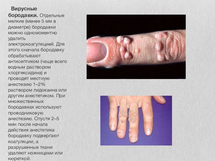 Вирусные бородавки. Отдельные мелкие (менее 5 мм в диаметре) бородавки можно одномоментно