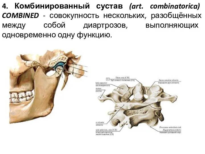 4. Комбинированный сустав (art. combinatorica) COMBINED - совокупность нескольких, разобщённых между собой