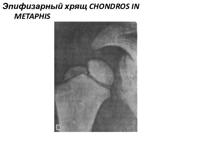 Эпифизарный хрящ CHONDROS IN METAPHIS