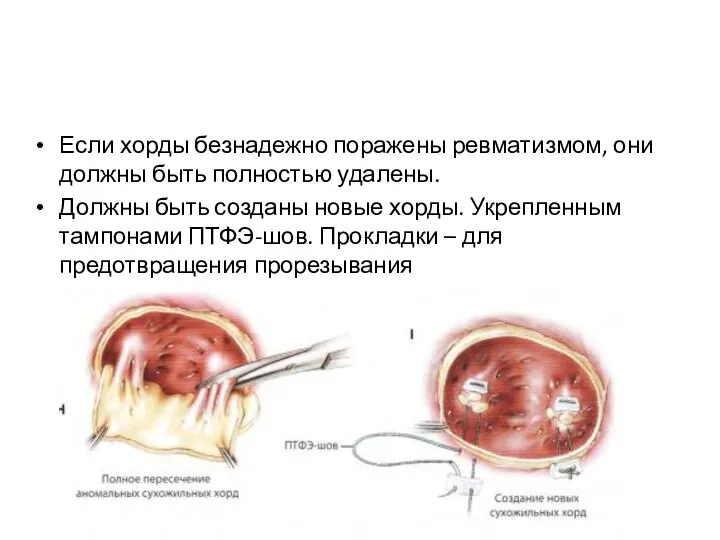 Если хорды безнадежно поражены ревматизмом, они должны быть полностью удалены. Должны быть