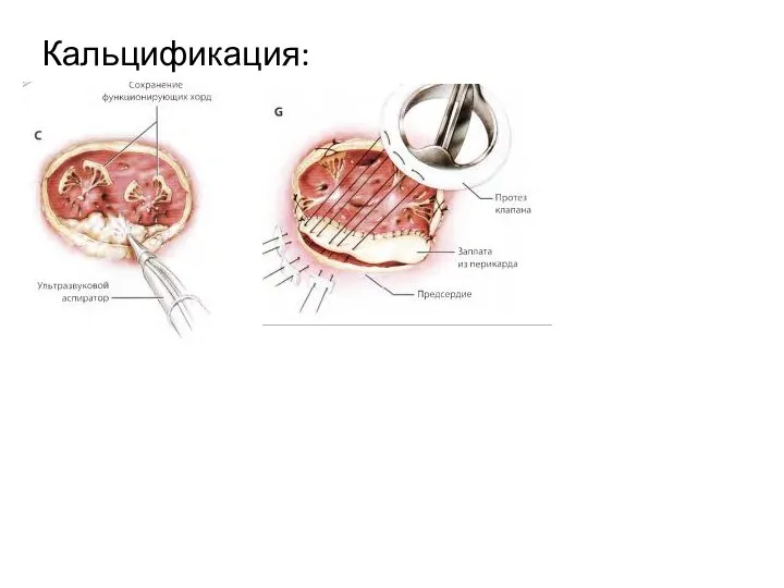 Кальцификация: