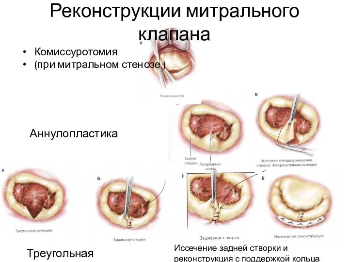 Реконструкции митрального клапана Комиссуротомия (при митральном стенозе ) Аннулопластика Треугольная резекция Иссечение