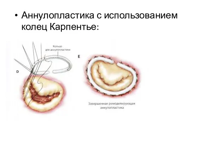 Аннулопластика с использованием колец Карпентье: