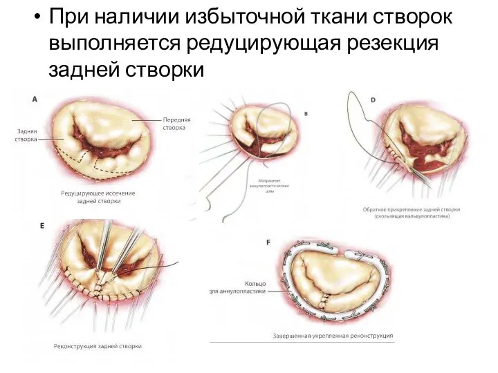 При наличии избыточной ткани створок выполняется редуцирующая резекция задней створки