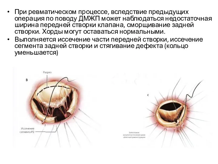 При ревматическом процессе, вследствие предыдущих операция по поводу ДМЖП может наблюдаться недостаточная