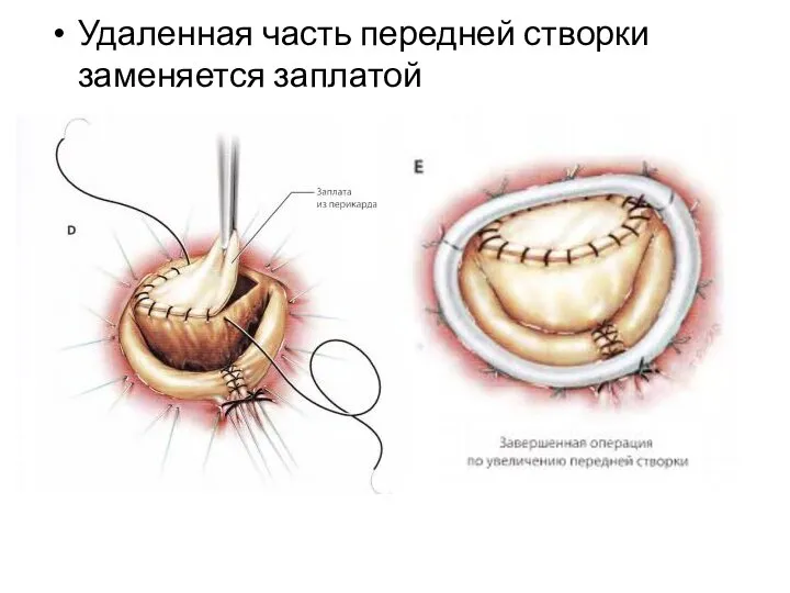 Удаленная часть передней створки заменяется заплатой