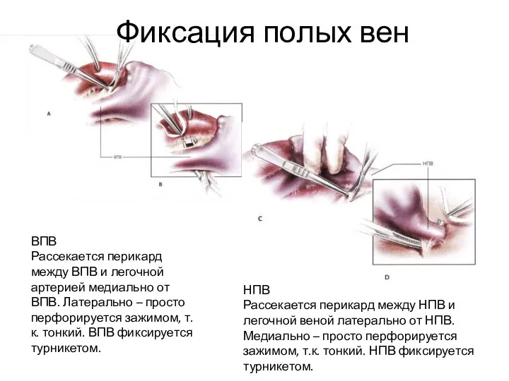 ВПВ Рассекается перикард между ВПВ и легочной артерией медиально от ВПВ. Латерально